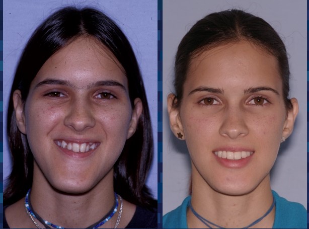 Before and after of a patient's maxillo-mandibular widening - Dr. Cesar Guerrero - Houston, TX